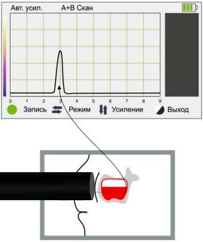Жидкость верхнечелюстной пазухи Жидкость верхнечелюстной пазухи