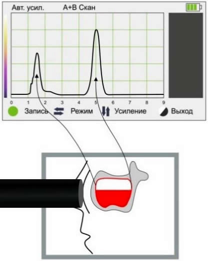 Жидкость в верхней пазухе Жидкость в верхней пазухе