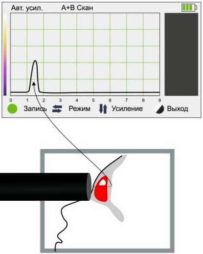 Жидкость лобной пазухи Жидкость лобной пазухи