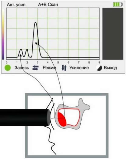 Киста пазухи Киста пазухи